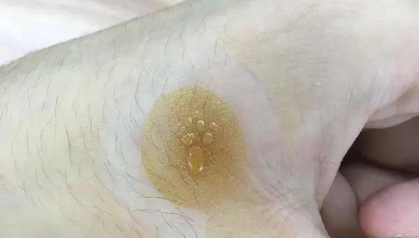 灸花，一種奇妙的花