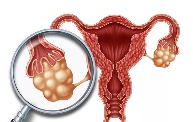 婦科“第一兇癌”！當出現這些癥狀時(shí)，婦科問(wèn)題艾灸灸什么穴位