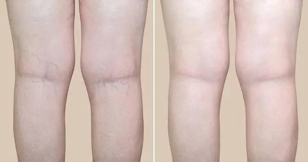 人老腳先衰，木枯根先竭，艾灸不能忘了灸腿！