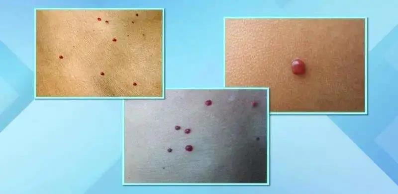 身上莫名其妙的出現血痣，怎么辦？